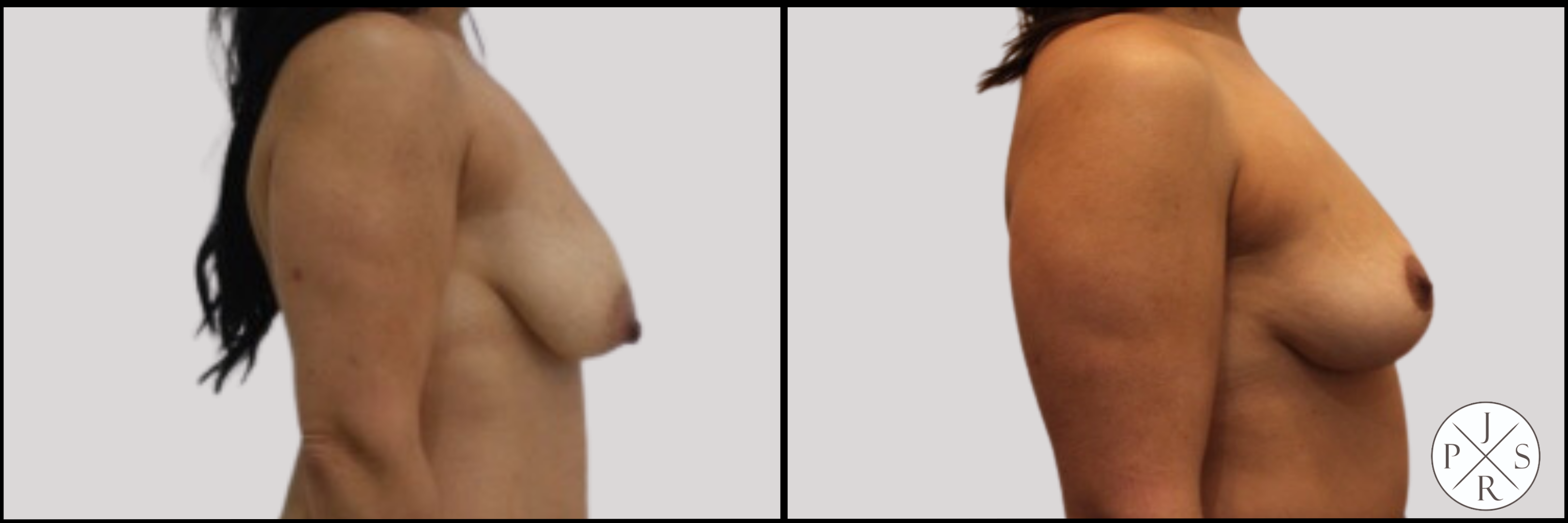 Fat Transfer Breast Augmentation Before & After Image